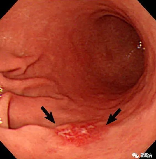 早期胃癌胃镜图片